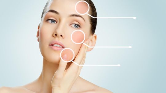 Jak rozpoznać cerę naczynkową? Zasady pielęgnacji.