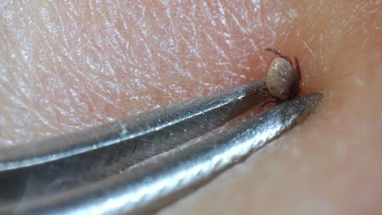 Kleszcze "miejskie" są gorsze niż te "leśne". Jak się przed nimi chronić i jak je usunąć?