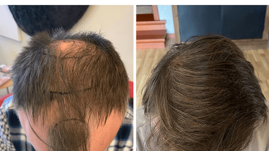 Praktyczne porady na temat przeszczepu włosów w Turcji